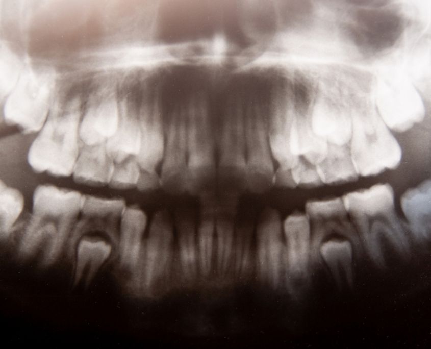 Dental X-ray of Child with Milk Teeth