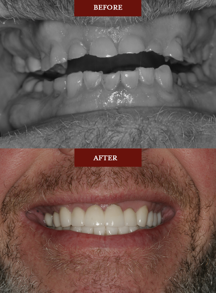 Before and After CEREC Crowns
