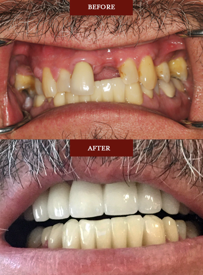 Full Restoration - Dental Associates