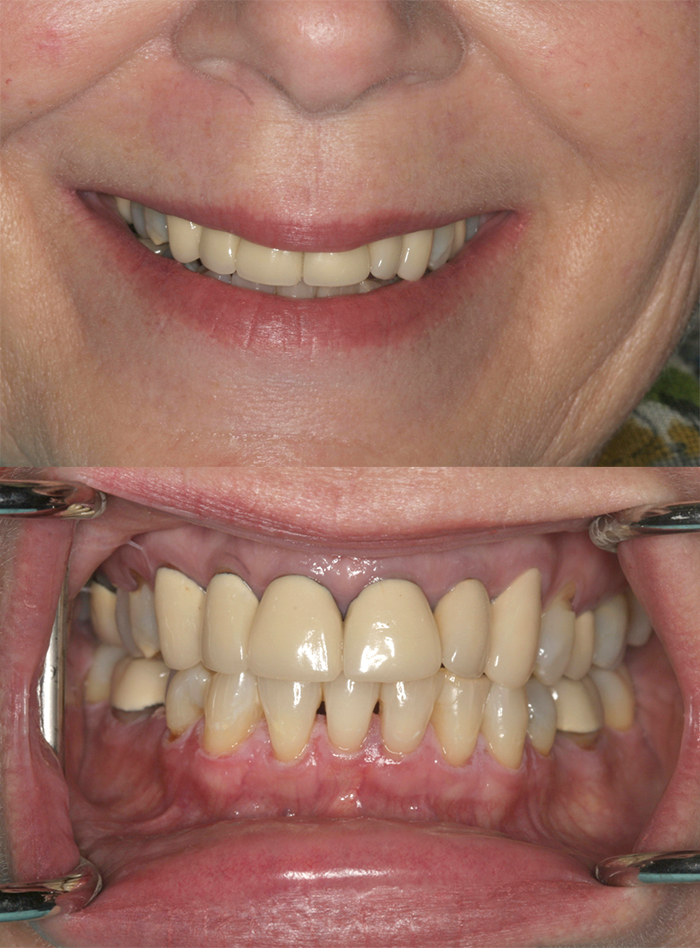 Full Upper Restoration - Dental Associates
