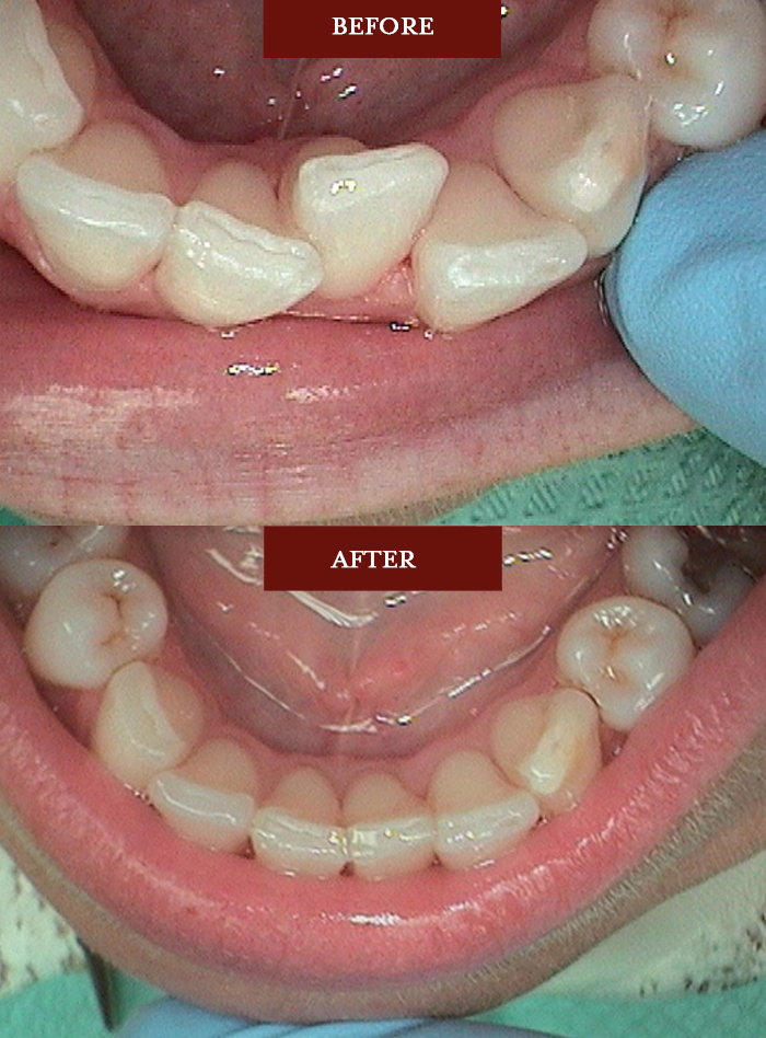 Sudline Teeth Alignment - Dental Associates